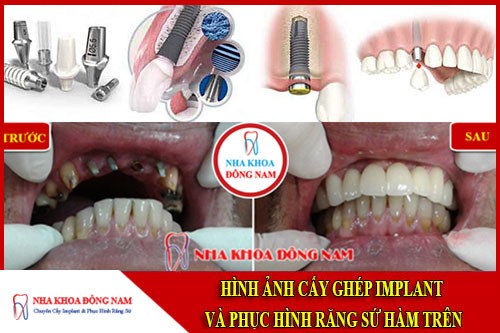 Cấy ghép Implant và phục Hình răng sứ hàm trên