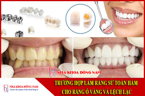 trường hợp làm răng sứ toàn hàm cho răng ố vàng và lệch lạc