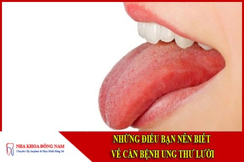 Những điều cần biết về căn bệnh ung thư lưỡi