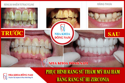 Phục hình răng sứ hai hàm bằng sứ HI-Zirconia