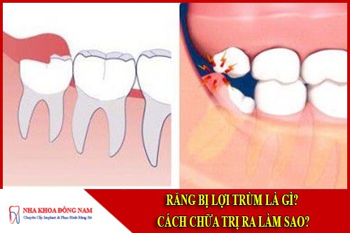 Răng bị lợi trùm là gì cách chữa trị ra làm sao