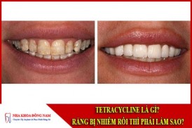 Tetracycline là gì - răng bị nhiễm kháng sinh thì phải làm sao