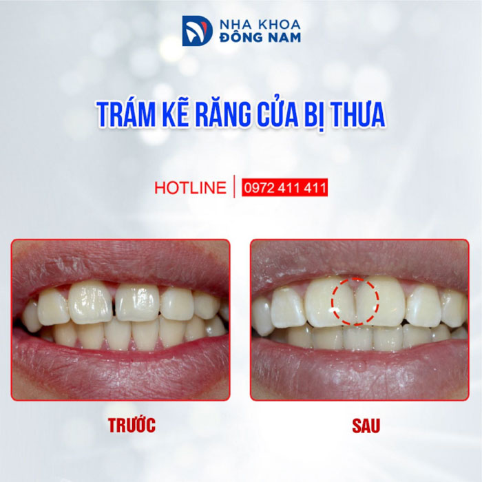 Trám răng thưa nhẹ