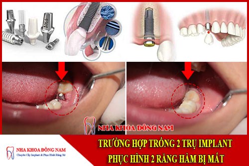 Cáy 2 trụ Implant phục hình 2 răng sứ