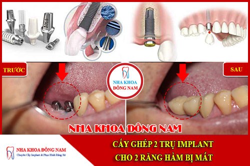 Cấy ghép 2 trụ implant cho 2 răng hàm bị mất