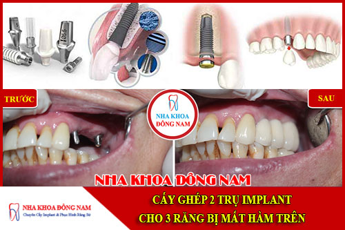 Cấy ghép 2 trụ Implant cho 3 răng bị mất hàm trên