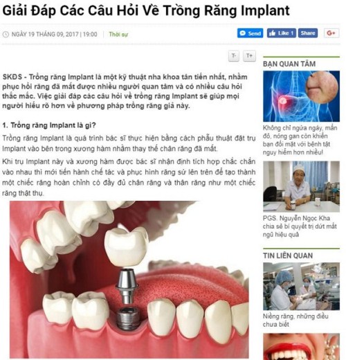 Giải đáp câu hỏi về trồng răng implant 1