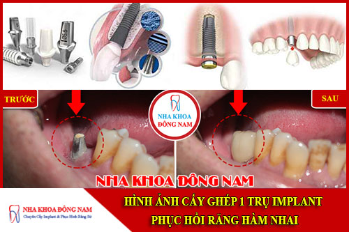 Hình ảnh cấy ghép 1 trụ implant phục hình răng đã mất hàm dưới
