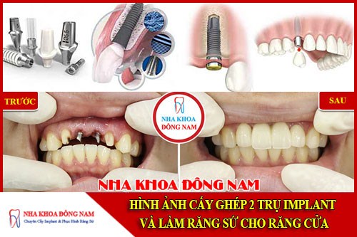 Hình ảnh cấy ghép 2 trụ implant và làm răng sứ