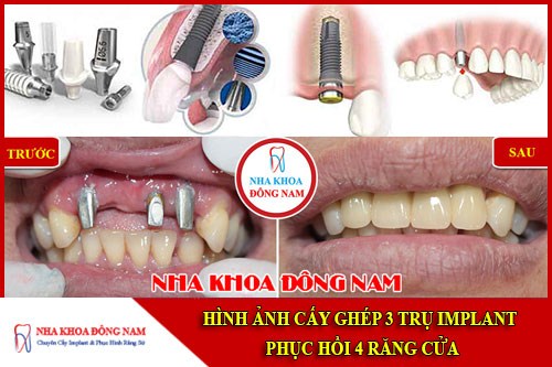 Hình ảnh cấy ghép 3 tru implant phục hồi 4 răng cửa bị mất