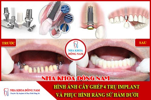 Hình ảnh cấy ghép 4 trụ implant và phục hình răng sứ hàm dưới