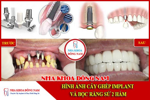Hình ảnh cấy ghép implant và bọc răng sứ hai hàm