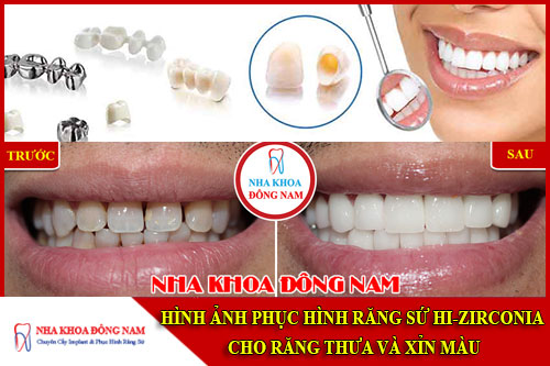 Hình ảnh phục hình răng sứ Hi-Zirconia cho răng thưa và xỉn màu