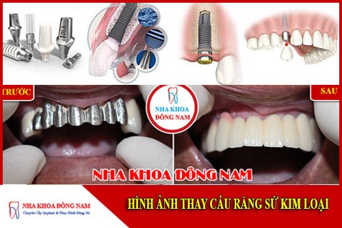 Thay cầu răng sứ kim loại