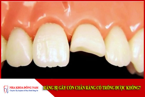 Răng gãy có trồng được không