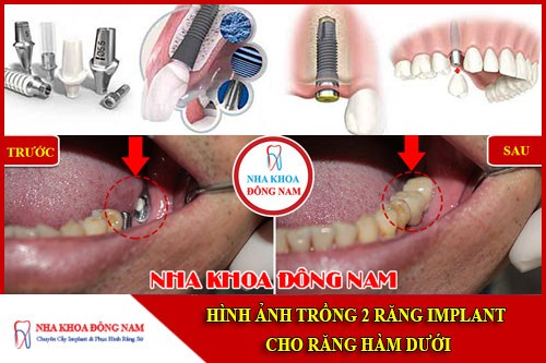 Trồng 2 răng Implant cho răng hàm dưới