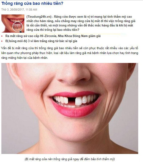 Trồng răng cửa bao nhiêu tiền 1