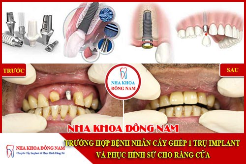 Trường hợp bệnh nhân cấy 1 trụ implant răng cửa