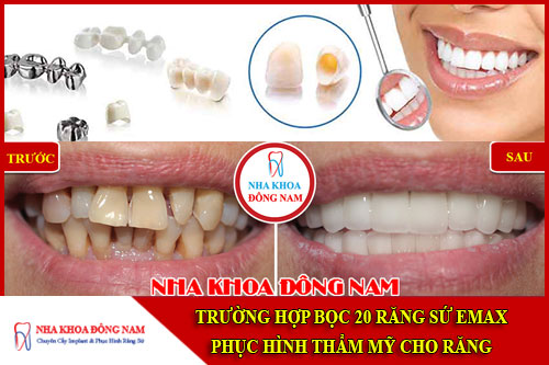 Trường hợp bọc 20 sứ Emax phục hình thẩm mỹ cho răng