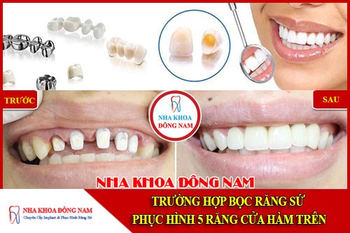 Trường hợp bọc răng sứ phục hình 5 răng cửa hàm trên