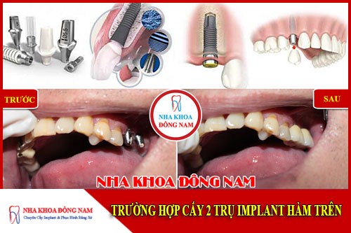 cấy ghép implant răng hàm trên