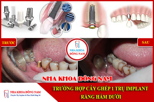 Trường hợp cấy ghép 1 trụ implant hàm dưới