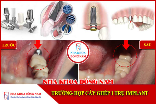 Trường hợp cấy ghép 1 trụ Implant