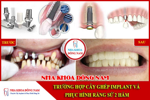 Trường hợp cấy ghép Implant và phục hình 2 hàm sứ
