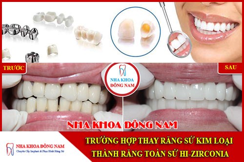 Trường hợp thay răng sứ kim loại bằng răng sứ Hi-Zirconia