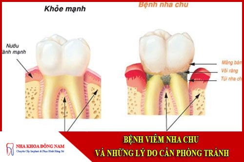 Bệnh viêm nha chu và những lý do cần phòng tránh