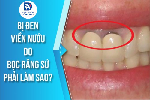 Bị đen viền nướu do bọc răng sứ thì khắc phục bằng cách nào?