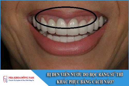 bị đen viền nướu do bọc răng sứ thì khắc phục bằng cách nào