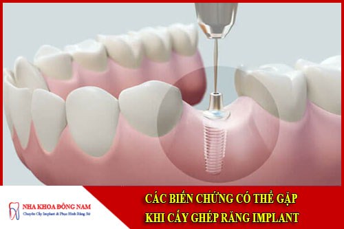 Các biến chứng có thể gặp khi cấy ghép implant
