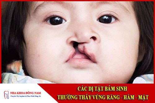 Các dị tật bẩm sinh thường thấy ở vùng răng hàm mặt