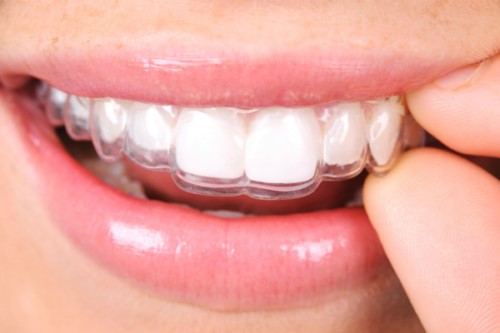 Các loại hàm duy trì sau niềng răng hiện nay - Nha Khoa Đông Nam®