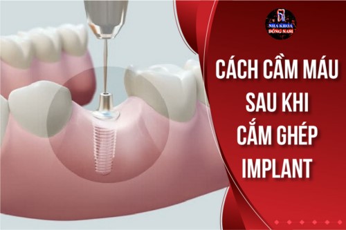 Cách cầm máu sau khi cắm ghép Implant