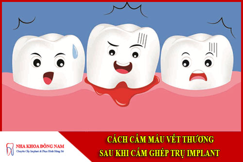 Cách cầm máu vết thương khi cấy ghép Implant