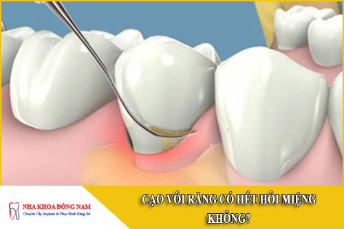 cạo vôi răng có hết hôi miệng không