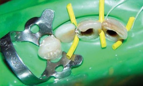 Chữa tủy răng có đặt thuốc diệt tủy không 5