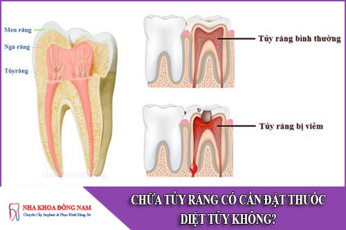 chữa tủy răng có cần đặt thuốc diệt tủy không