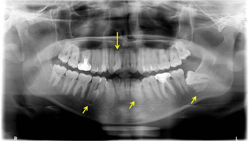 Chụp X-quang giúp quan sát toàn diện tình trạng răng mọc thừa