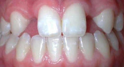 cấy ghép Implant cho người thiếu răng bẩm sinh-1