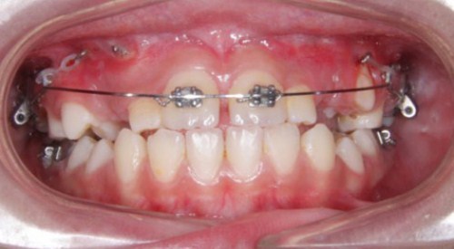 cấy ghép Implant cho người thiếu răng bẩm sinh-4