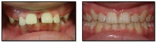 cấy ghép Implant cho người thiếu răng bẩm sinh-6