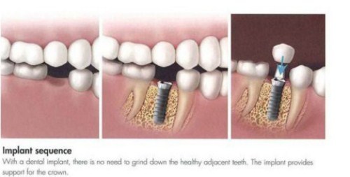 cấy ghép Implant cho người thiếu răng bẩm sinh-8