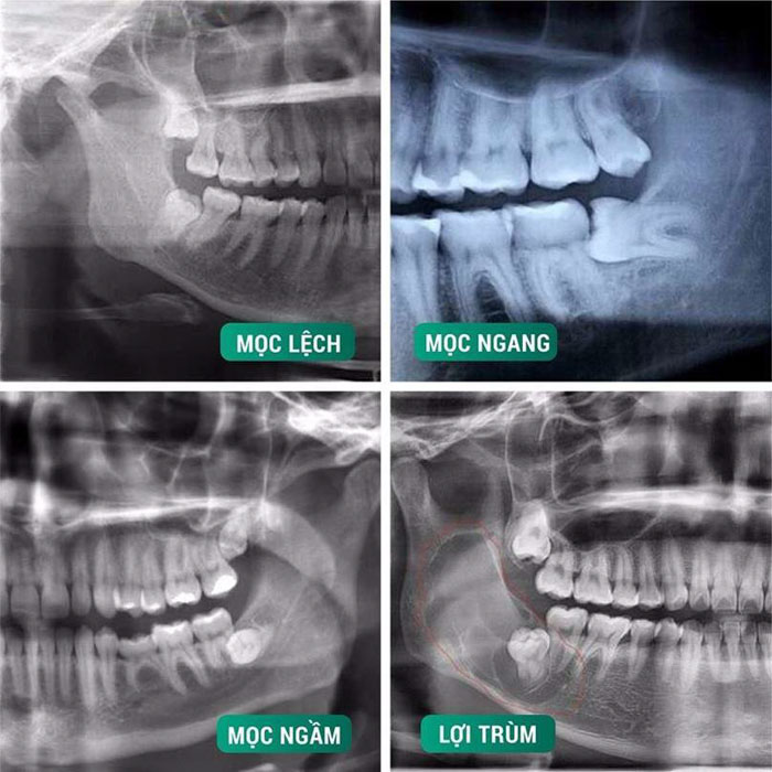 Khi răng khôn mọc sai lệch thường tiềm ẩn nhiều biến chứng nguy hiểm