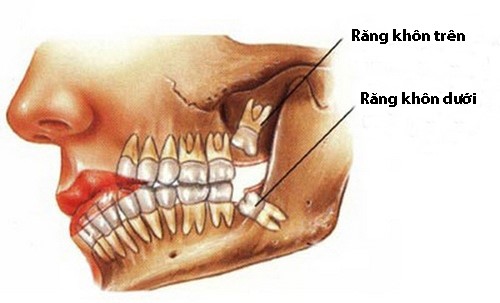 răng khôn
