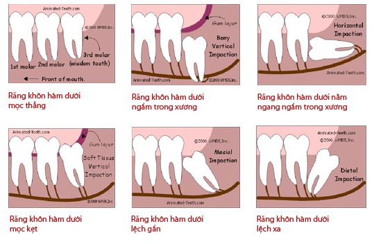 Răng khôn không mọc là hiện tượng gì 2