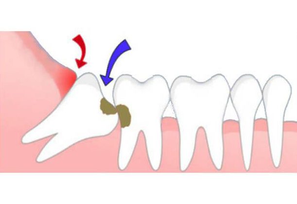 Răng khôn không mọc là hiện tượng gì 3