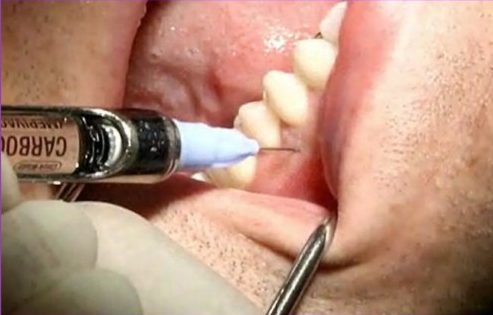 Kỹ thuật gây tê trong điều trị tủy răng 1